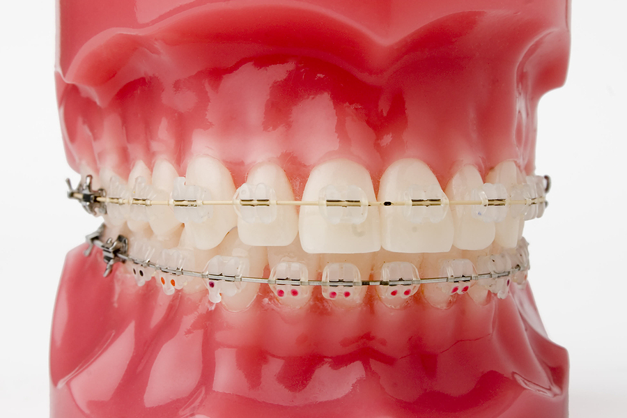 Transform Your Smile with Braces in Flat Rock, NC