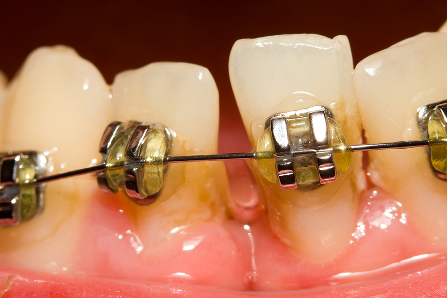 Braces: Your Path to a Straighter, Healthier Smile in Flat Rock, NC