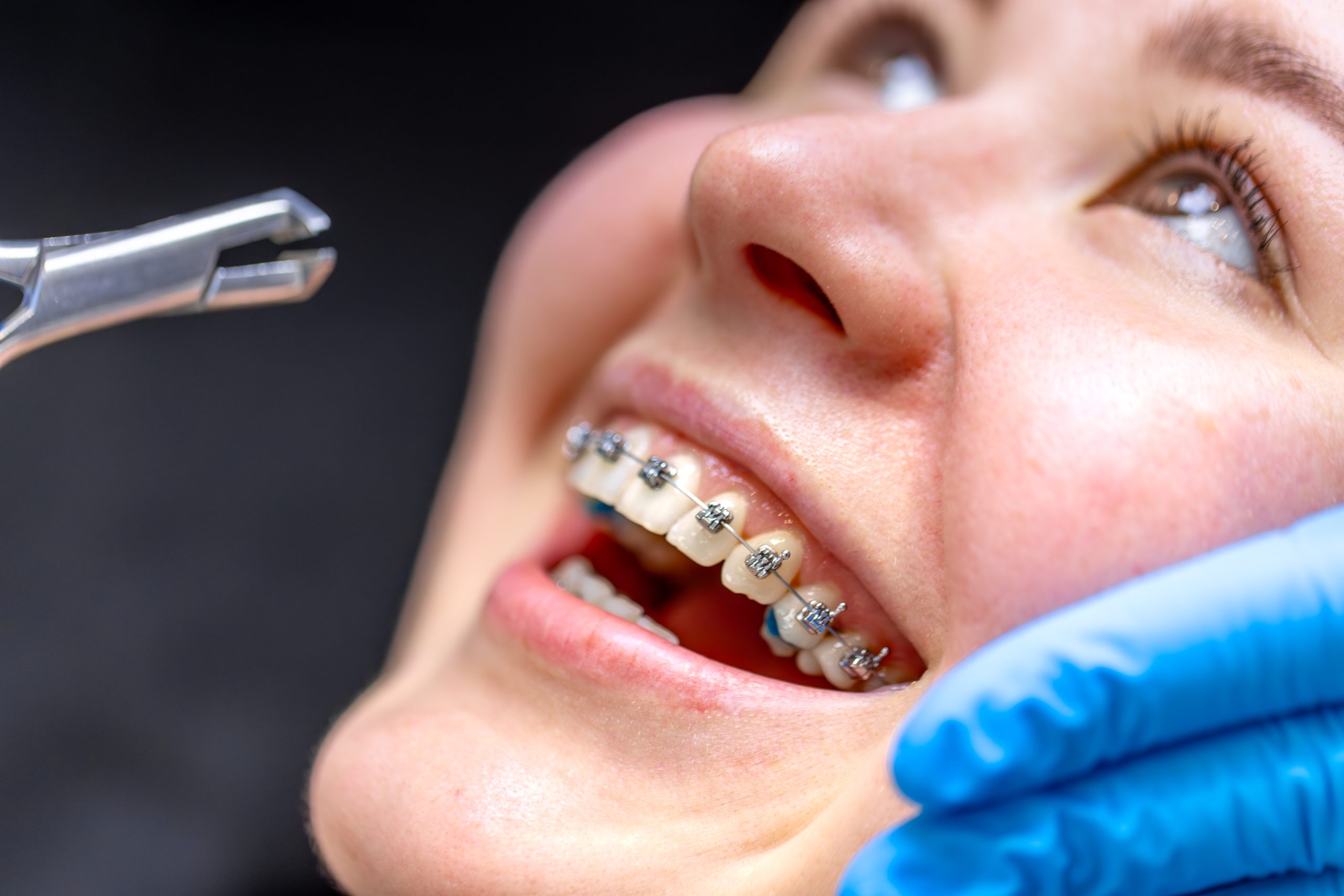 Achieve a Perfect Smile with Braces in Flat Rock, NC