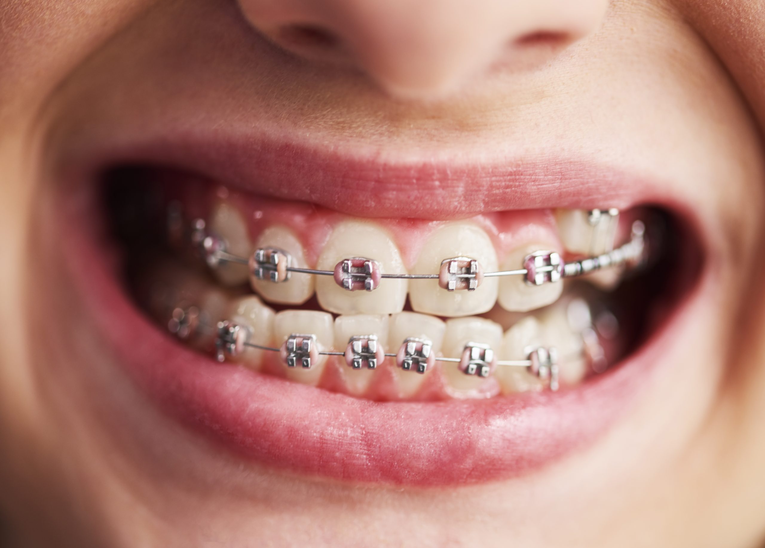 Everything You Need to Know About Braces in Flat Rock, NC