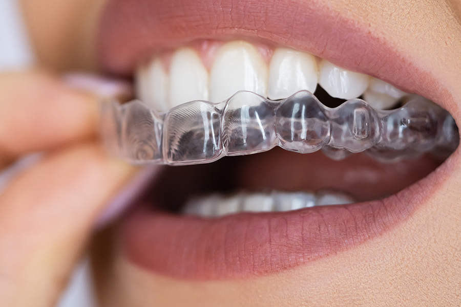 Achieving a Perfect Smile with Clear Aligners in Flat Rock, NC