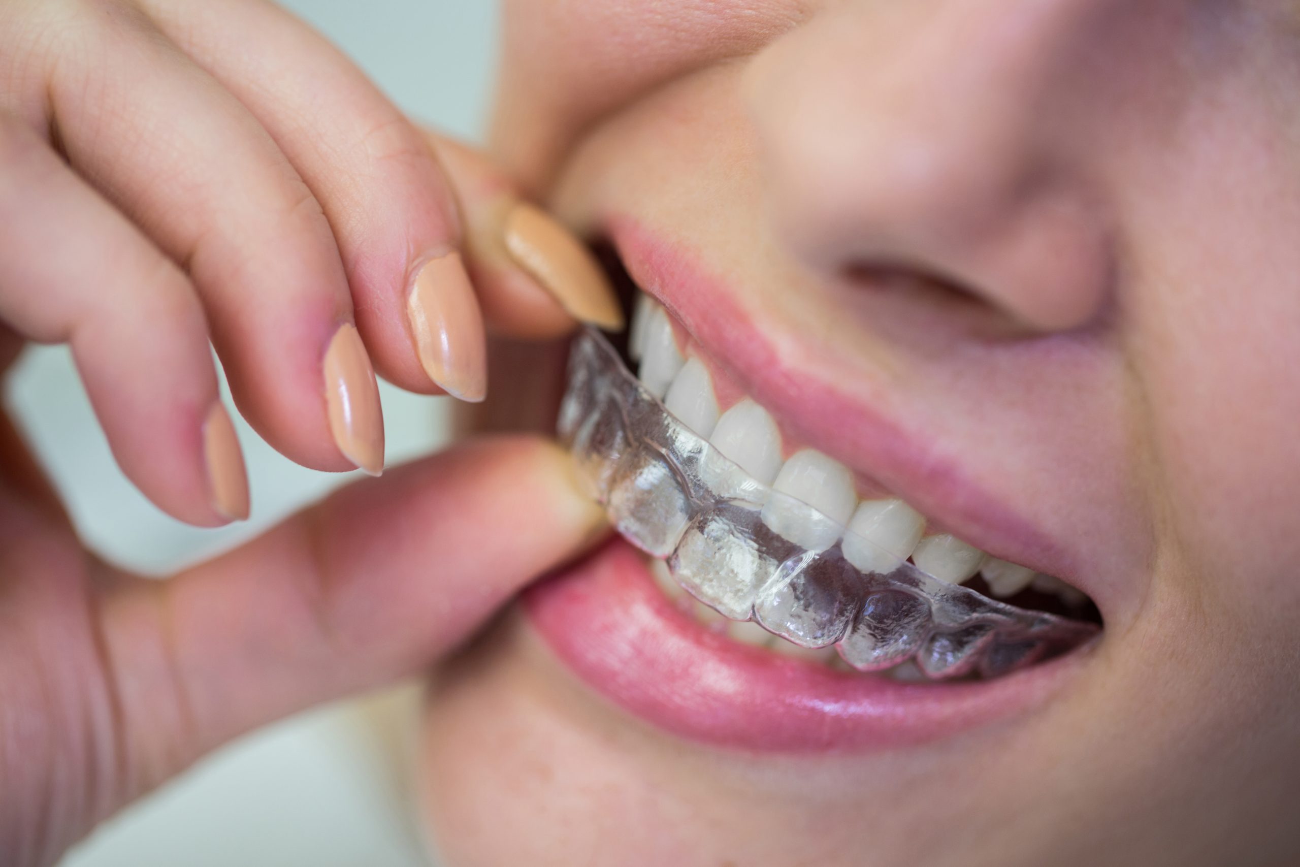 Achieve a Perfect Smile with Clear Aligners in Flat Rock, NC